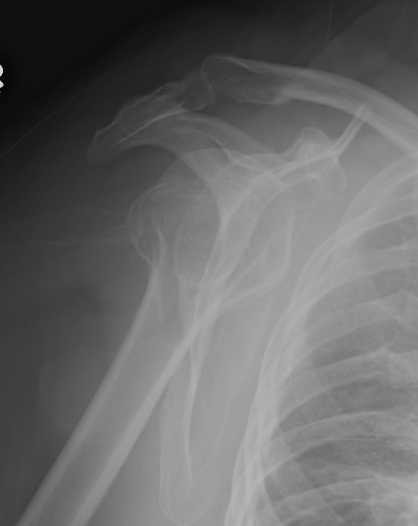 Shoulder Post Dislocation Check Reduction